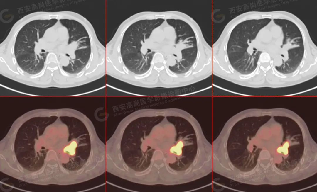 高尚病例：PET/CT 病例：肺鳞癌 5 例