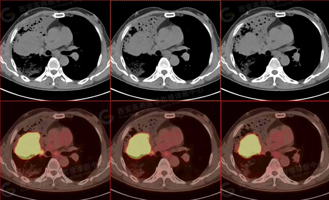高尚病例：PET/CT 病例：肺鳞癌 5 例