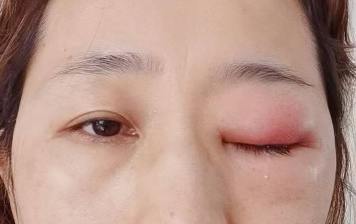 武汉普瑞眼科医院：眼部红肿非小事，警惕"眼眶蜂窝织炎"凶险