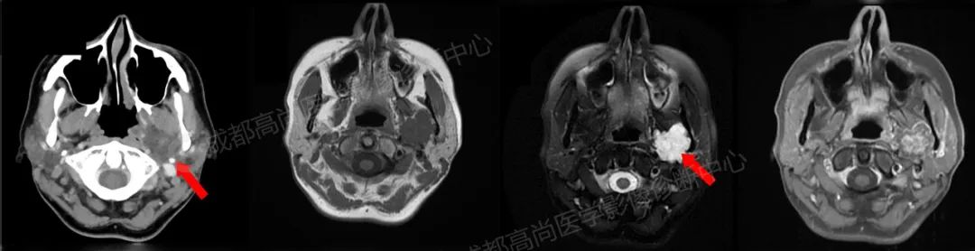 高尚病例：PET/CT 诊断腮腺腺淋巴瘤 1 例