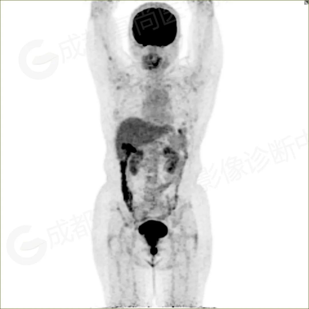 高尚病例：PET/CT 诊断尿道平滑肌肉瘤 1 例