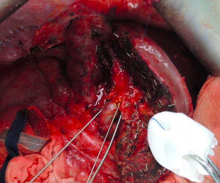 病例分享：巨大肝脏转移胃间质瘤治疗案例-临床综合诊治及讨论分析