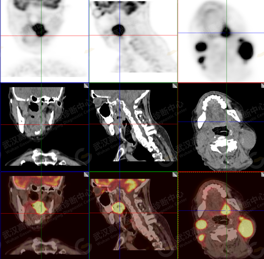高尚病例：18F-FDG PET/CT 诊断扁桃体癌 3 例