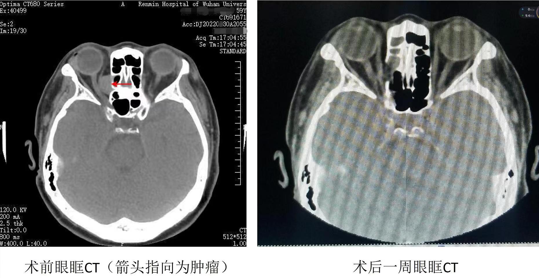 眼-鼻联合突破手术禁区：武汉大学人民医院眼耳鼻喉医院用鼻内镜「智」取眼眶肿瘤