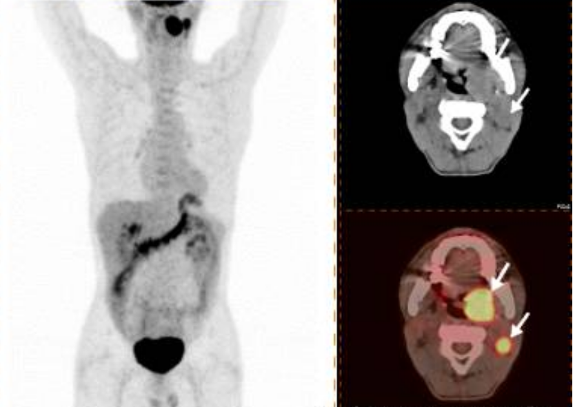 高尚病例：18F-FDG PET/CT 诊断扁桃体癌 3 例