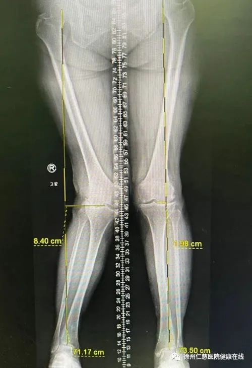 膝关节重度外翻畸形，徐州仁慈医院智能导航下行全膝关节置换术