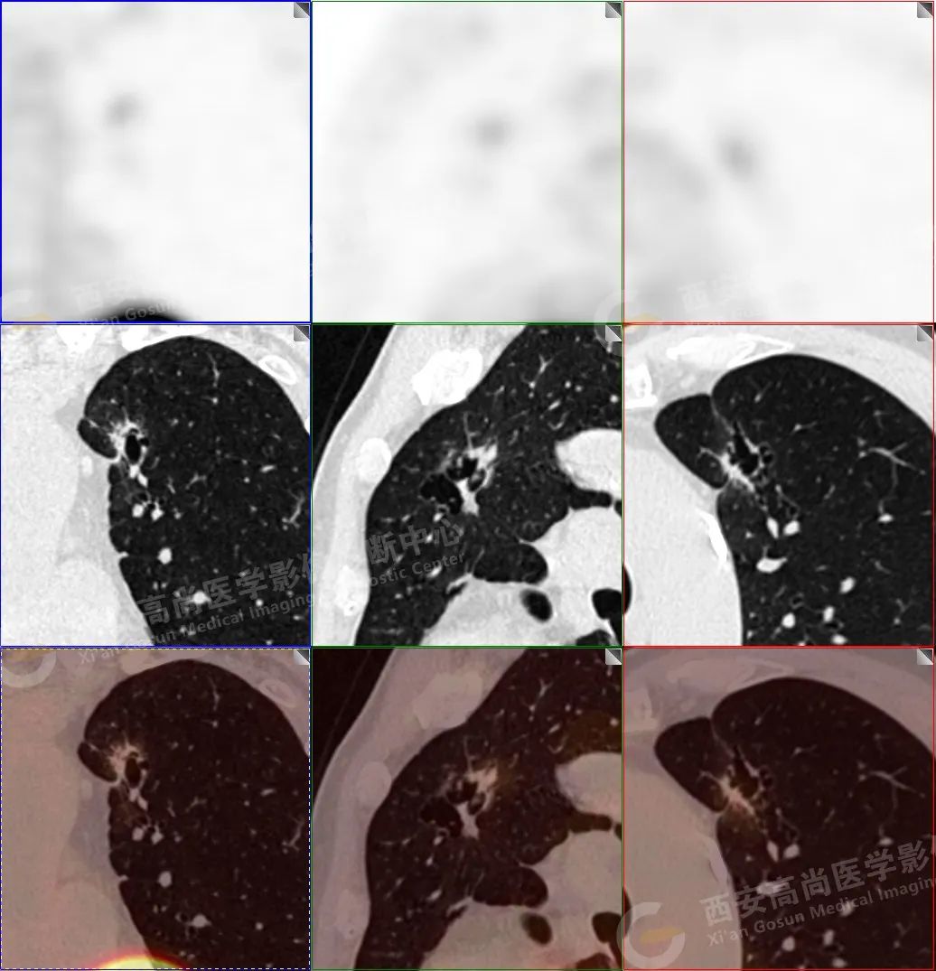 高尚病例：PET-CT 病例囊腔性肺癌 5 例
