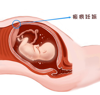 剖宫产和自然分娩，怀孕的你打算怎么选？