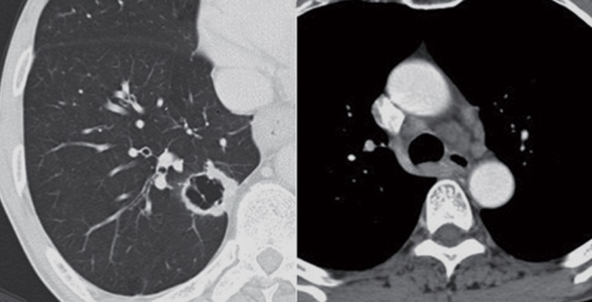 高尚病例：PET-CT 病例囊腔性肺癌 5 例