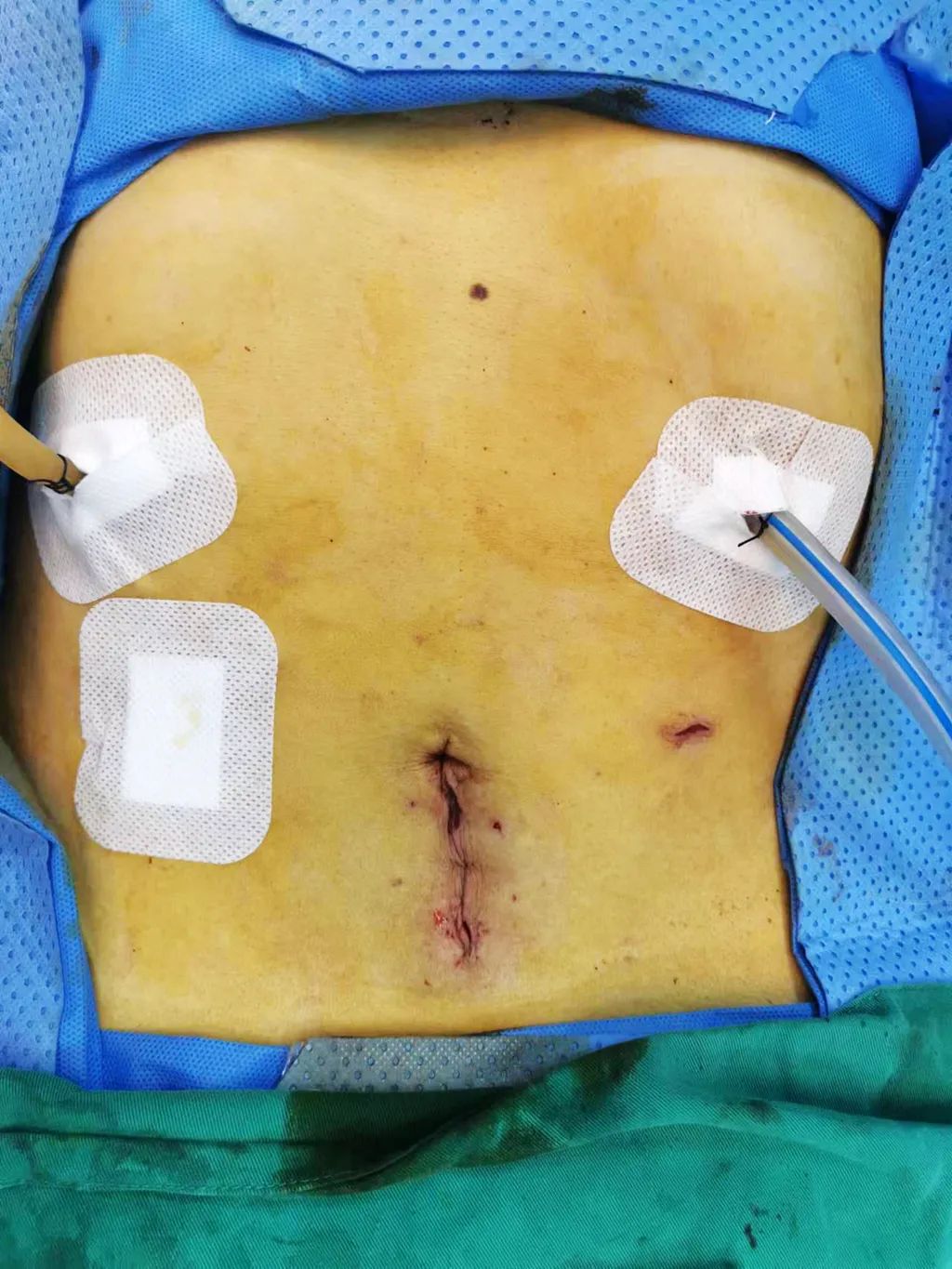 据说这个治疗胆管癌的手术是普外科手术的「天花板」