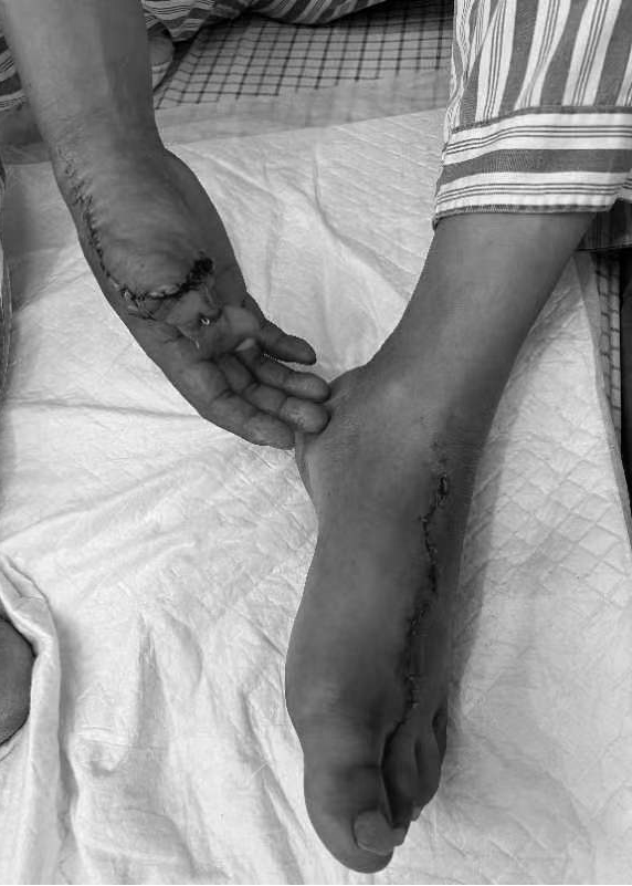 移脚趾接「拇指」| 桂医二附院成功完成一例复杂拇指再造术