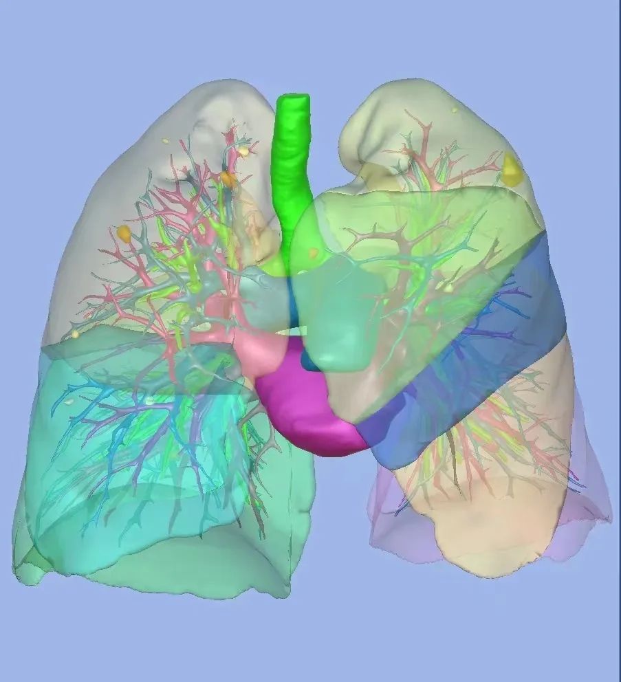 精准诊疗|双肺 8 个肺结节 胸外科专家一次微创手术「一网打尽」