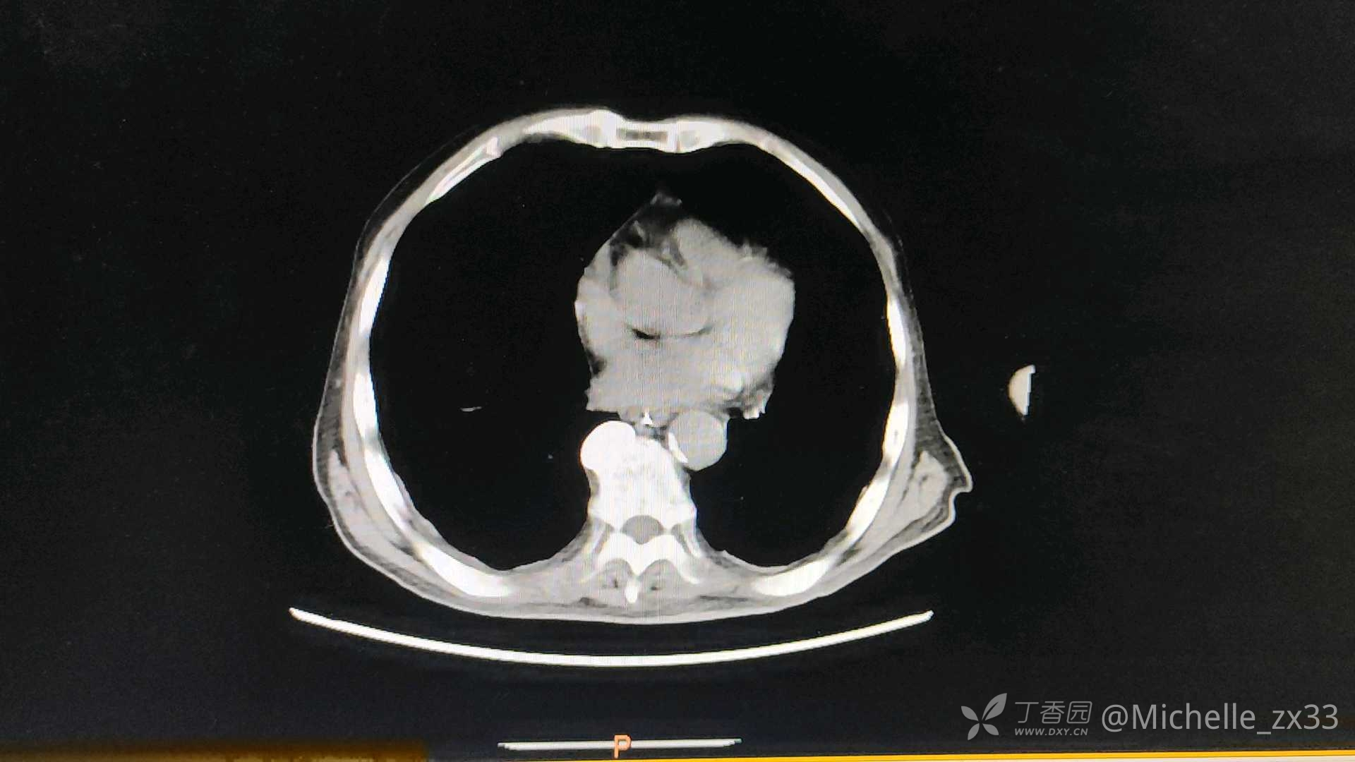 腹部ct肠腔广泛高密度影