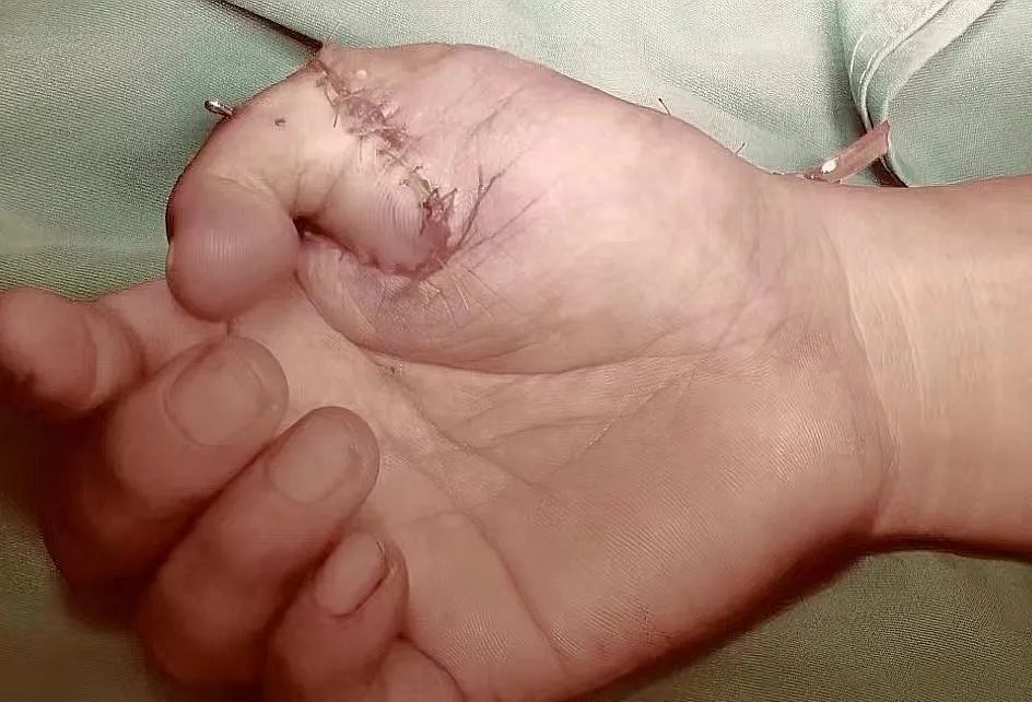 移脚趾接「拇指」| 桂医二附院成功完成一例复杂拇指再造术