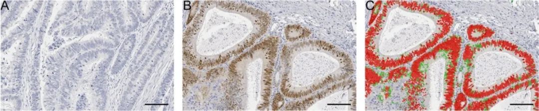 TissueFAXS Cytometry技术：SOX2 +细胞密度对结直肠癌患者预后和预测价值评估