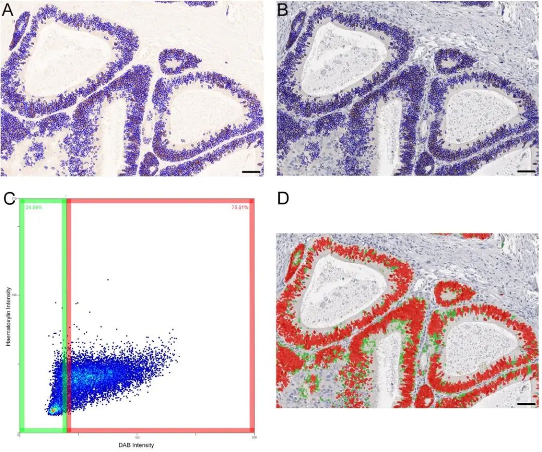 TissueFAXS Cytometry技术：SOX2 +细胞密度对结直肠癌患者预后和预测价值评估
