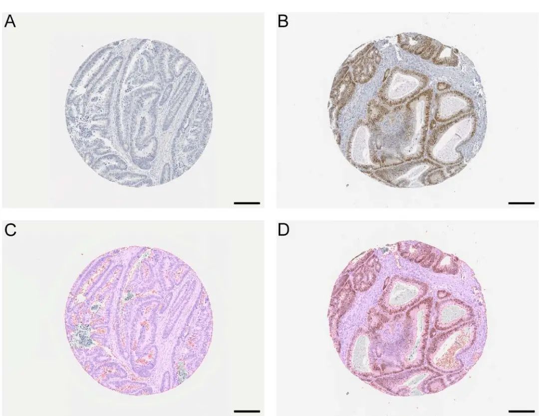 TissueFAXS Cytometry技术：SOX2 +细胞密度对结直肠癌患者预后和预测价值评估