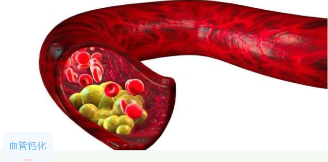 能解毒还能防治血管钙化——硫代硫酸钠