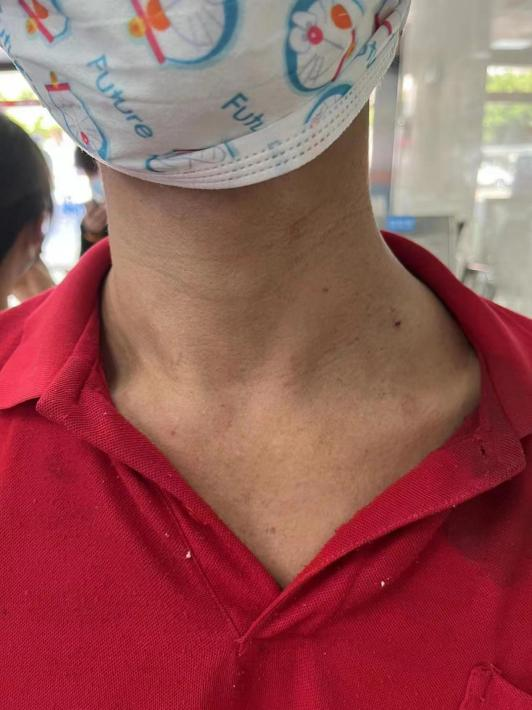 男子颈外伤后,脖子竟流出「牛奶样」液体