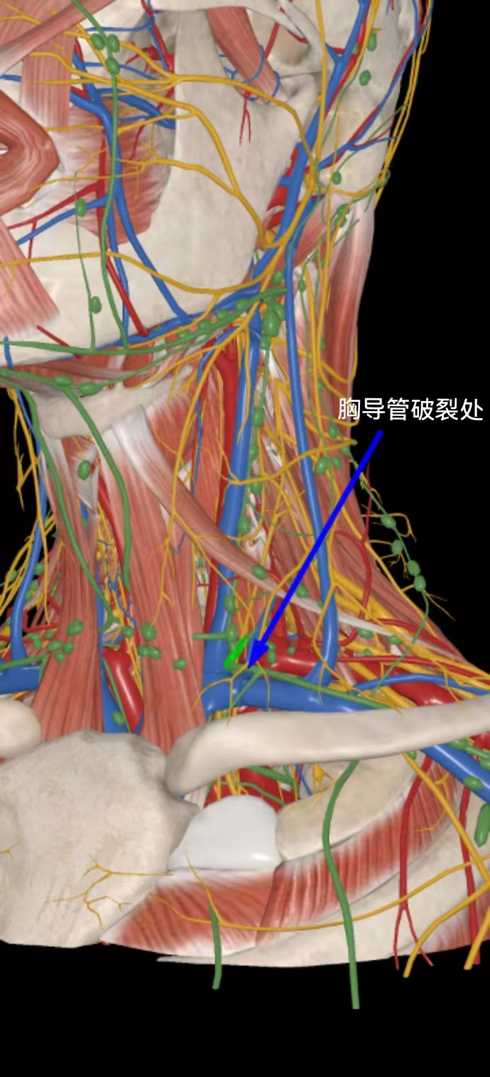 男子颈外伤后,脖子竟流出「牛奶样」液体