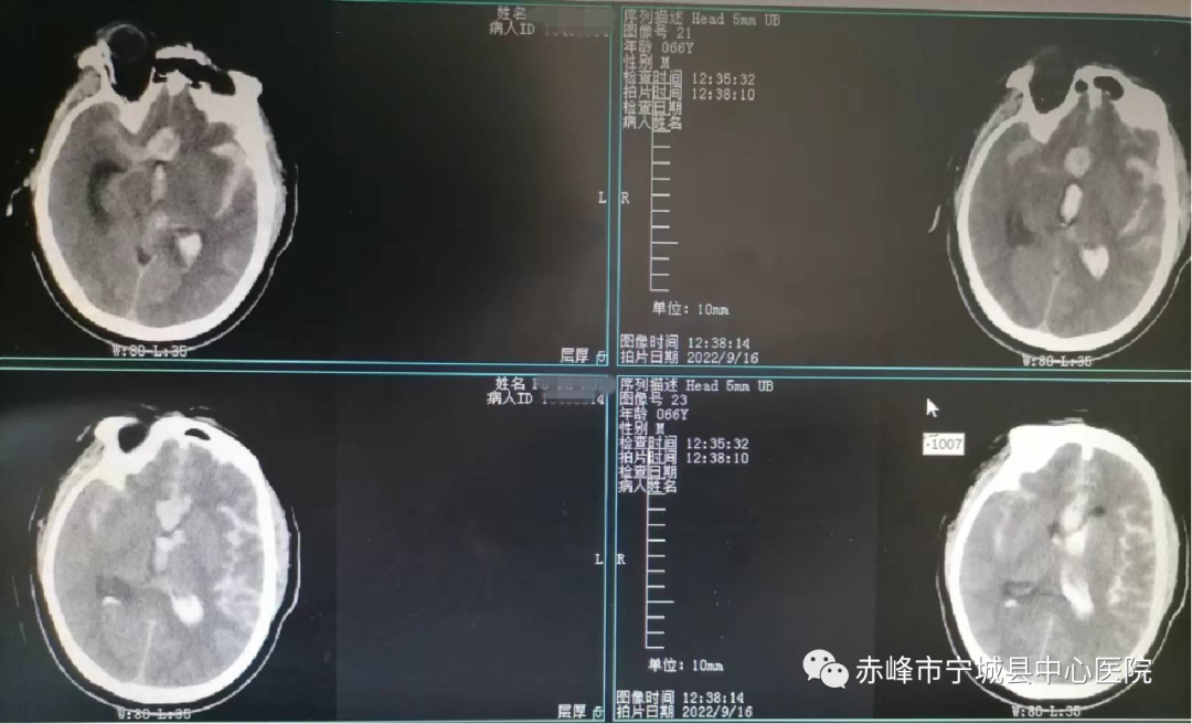 精准定位 脑内「拆弹」——宁城县中心医院神经外二科：特重型多发前交通动脉瘤破裂栓塞治疗