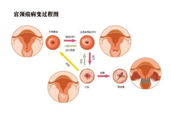 宫颈癌可以治愈吗？