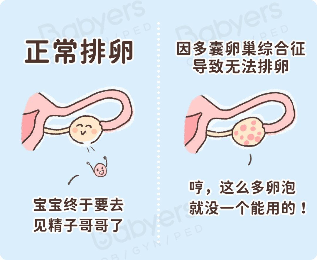 多囊卵巢?几个大招,自然怀也没那么难!