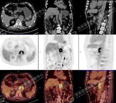 高尚病例：PET/CT-CTA 多模态诊断穿透性动脉粥样硬化性溃疡（PAU）一例