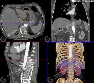 高尚病例：PET/CT-CTA 多模态诊断穿透性动脉粥样硬化性溃疡（PAU）一例