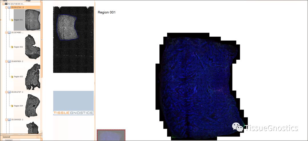 3分钟带你分析“PD-1/PD-L1”肿瘤免疫治疗方面实例