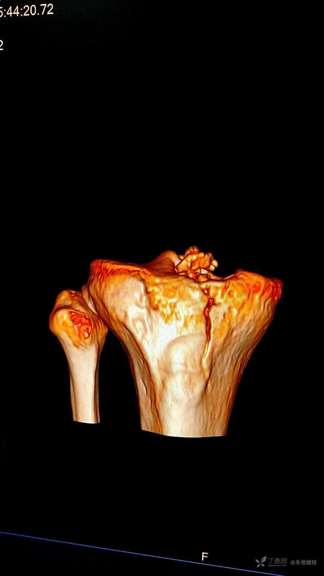 右胫骨髁间隆突图片图片