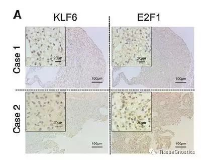 中国人民解放军总医院：KLF6通过抑制E2F1转录从而降低透明细胞型肾癌（ccRcc）的转移