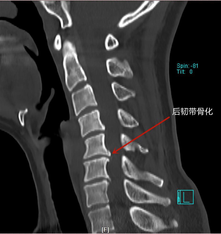 苏州京东方医院椎前路椎管减压术成功开展