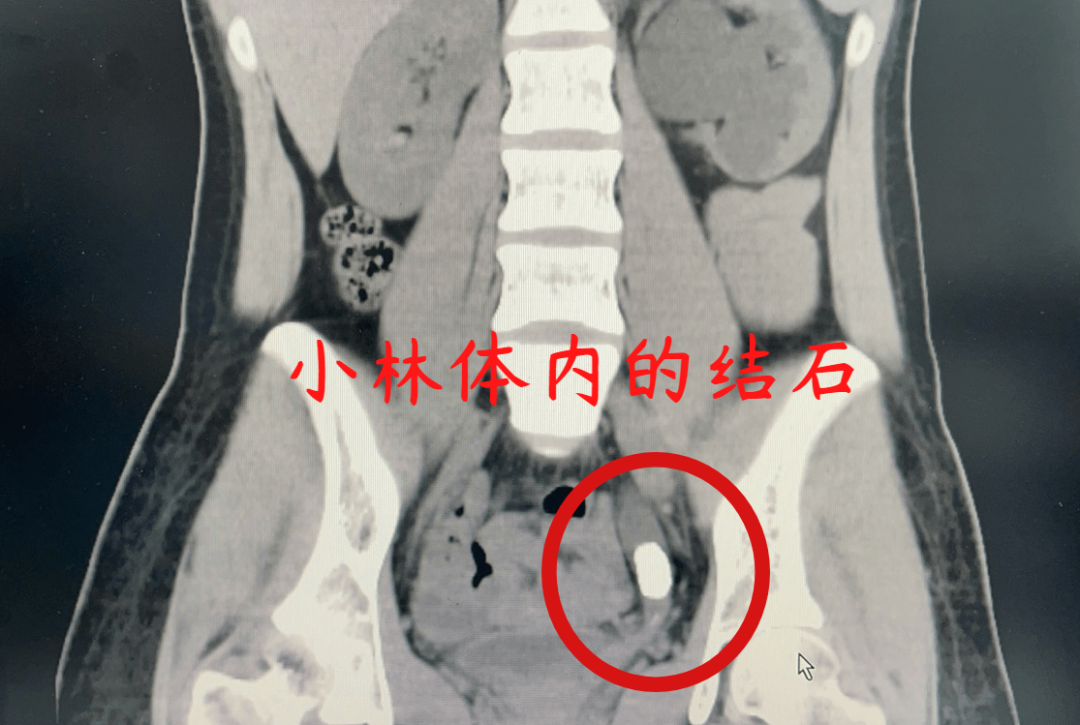 月经+输尿管完全堵死，深圳市萨米医疗中心肾造瘘术救治患者