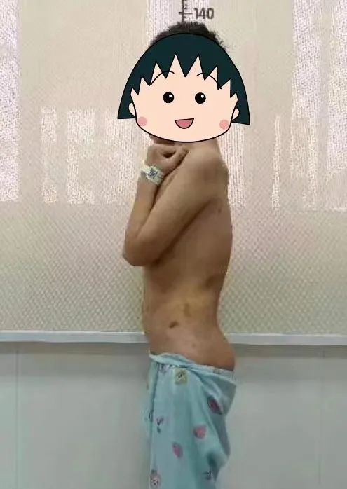 金钗女孩腰如弯弓，桂医附院脊柱外科迎难而上成功手术助其重获「挺拔人生」