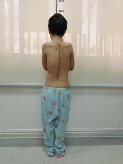 金钗女孩腰如弯弓，桂医附院脊柱外科迎难而上成功手术助其重获「挺拔人生」