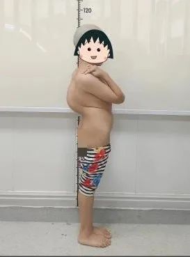 金钗女孩腰如弯弓，桂医附院脊柱外科迎难而上成功手术助其重获「挺拔人生」