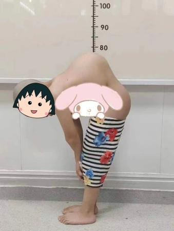 金钗女孩腰如弯弓，桂医附院脊柱外科迎难而上成功手术助其重获「挺拔人生」