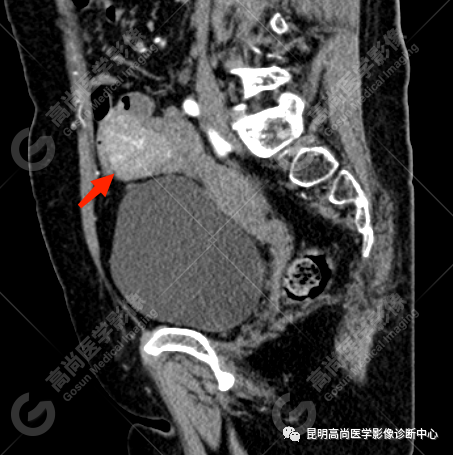 高尚病例：小肠间质瘤一例