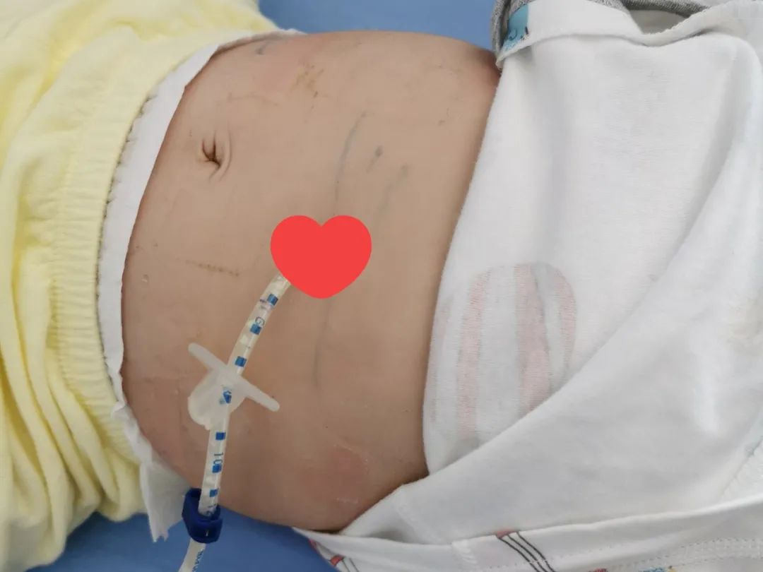 深圳市妇幼保健院福强儿内科完成 1 例婴儿甲基丙二酸血症经皮内镜下胃造瘘术