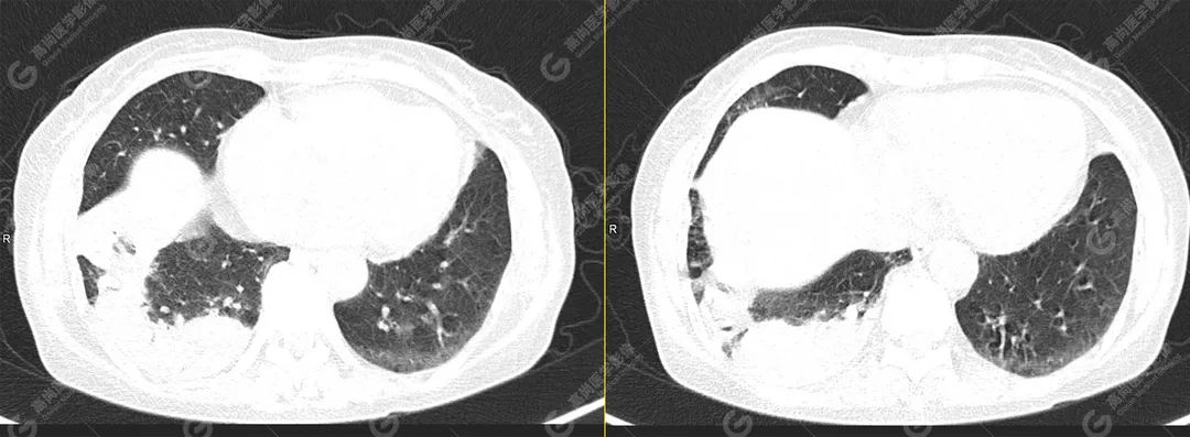 高尚病例：PET/CT 发现右肺隐球菌感染 1 例