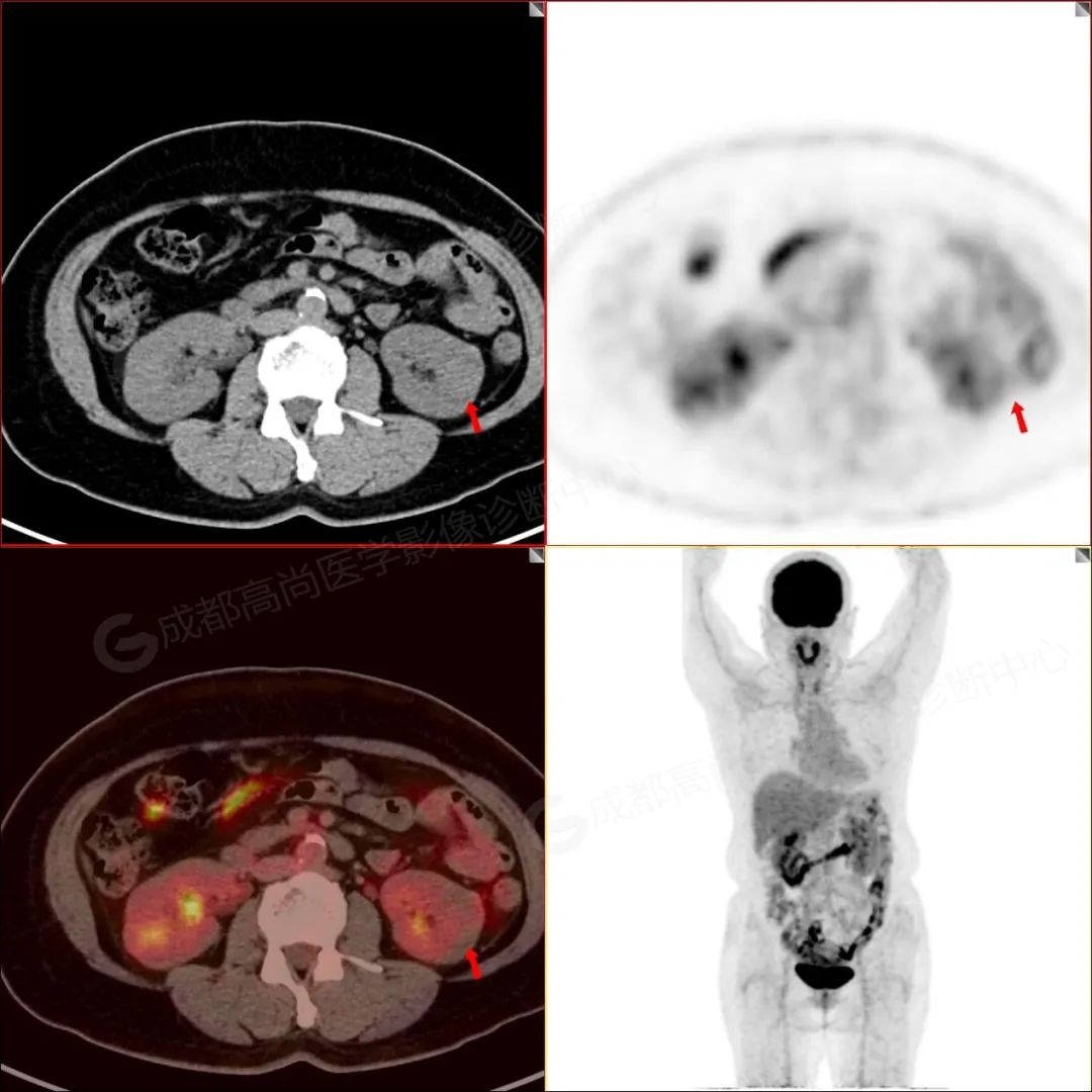 高尚病例：PET/CT 诊断宫颈癌术后肾透明细胞癌 1 例