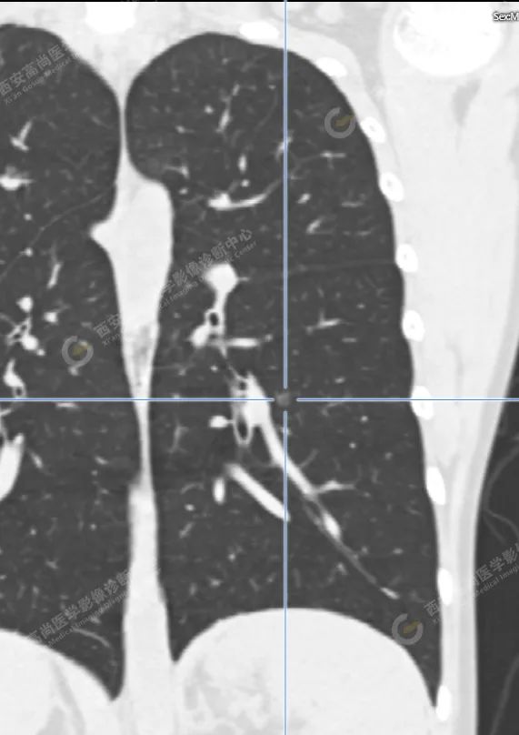 CT 病例：11 岁儿童双肺多发磨玻璃临床决策