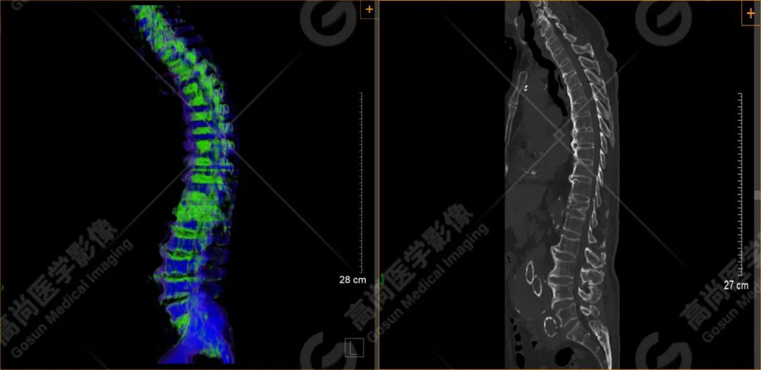 双源 CT 骨髓成像在脊柱骨折鉴别诊断中的应用分析