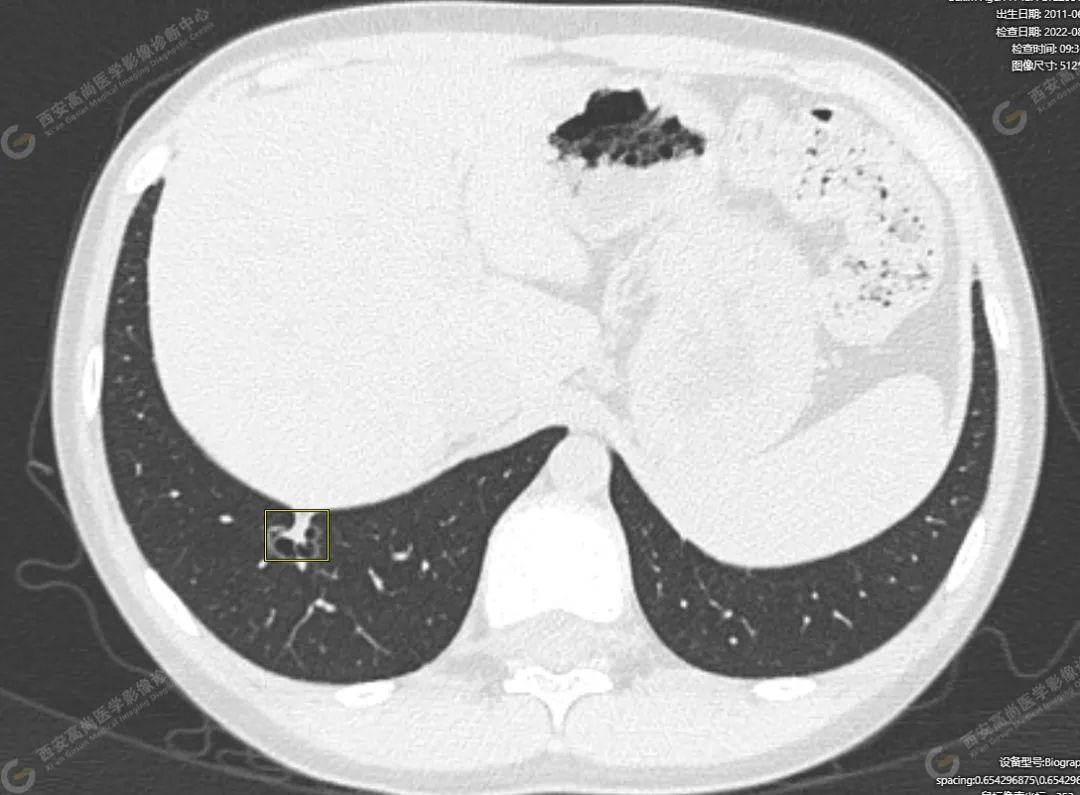 CT 病例：11 岁儿童双肺多发磨玻璃临床决策