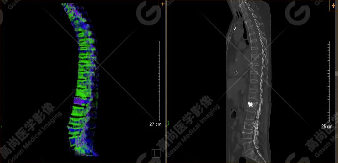 双源 CT 骨髓成像在脊柱骨折鉴别诊断中的应用分析