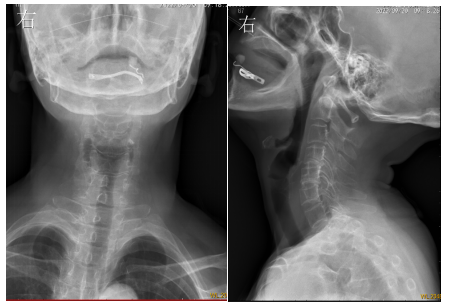颈椎肿瘤内压脊髓、外压椎动脉，好危险！脊柱外科成功拆除「定时炸弹」