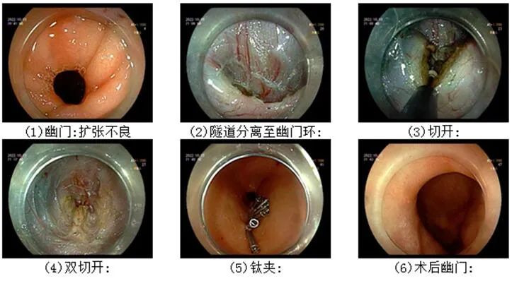 桂林一女子频繁呕吐、腹痛，竟是胃瘫痪了！内镜微创手术快速缓解病痛