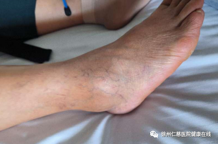 香蕉皮引发右踝关节损伤，徐州仁慈右踝关节镜下韧带修复救治病人