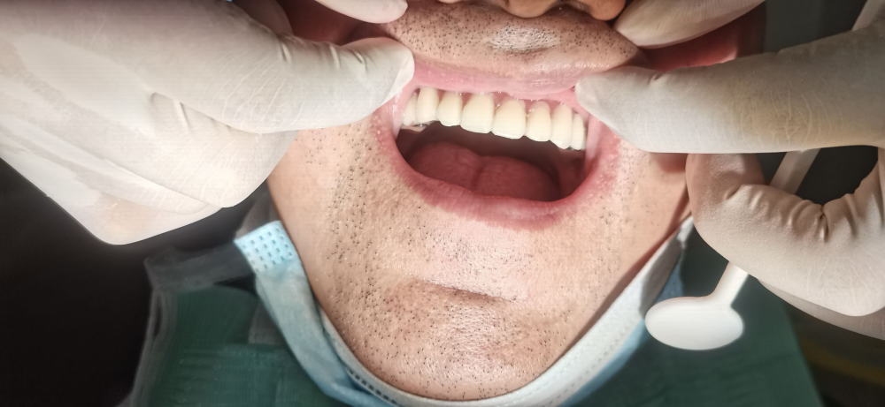 北京大学第三医院延安分院（延安市中医医院）成功开展院内首例种植后即刻义齿修复上颌牙列缺失